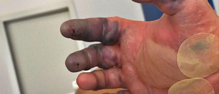 Un giovane turista perde due dita della mano dopo il morso di un ragno a Ibiza